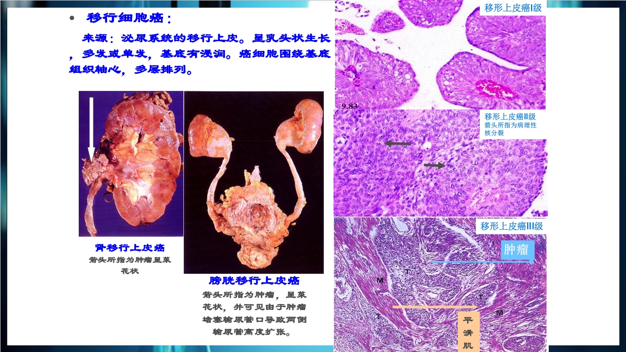 肿瘤病理学简介PPT课件下载33