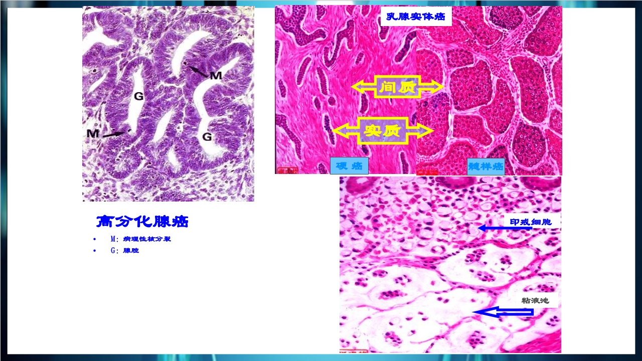 肿瘤病理学简介PPT课件下载35