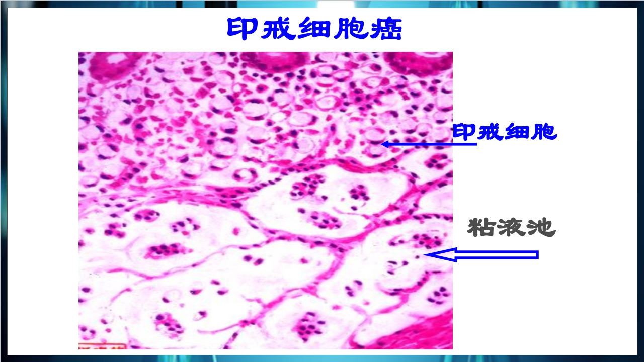 肿瘤病理学简介PPT课件下载36