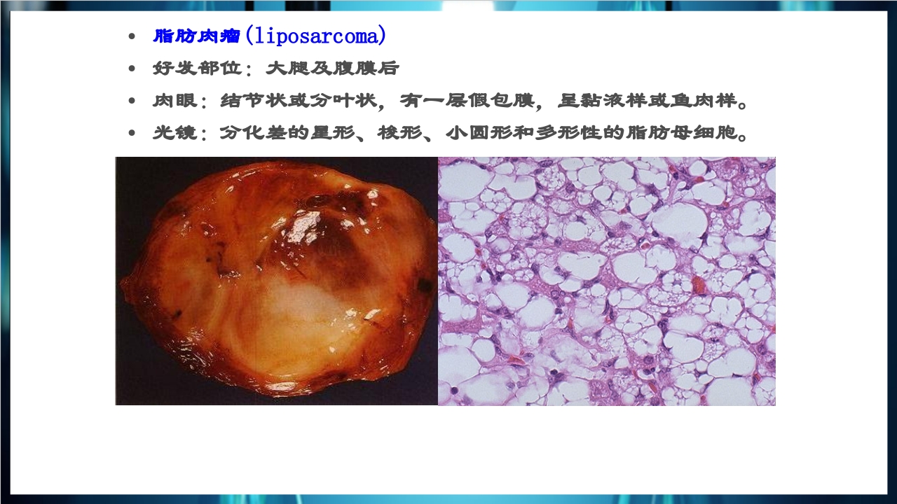 肿瘤病理学简介PPT课件下载41