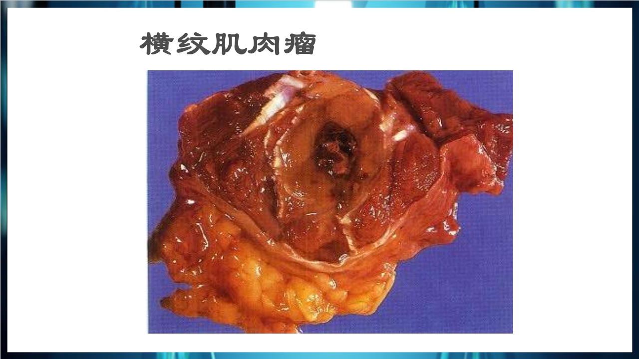 肿瘤病理学简介PPT课件下载42