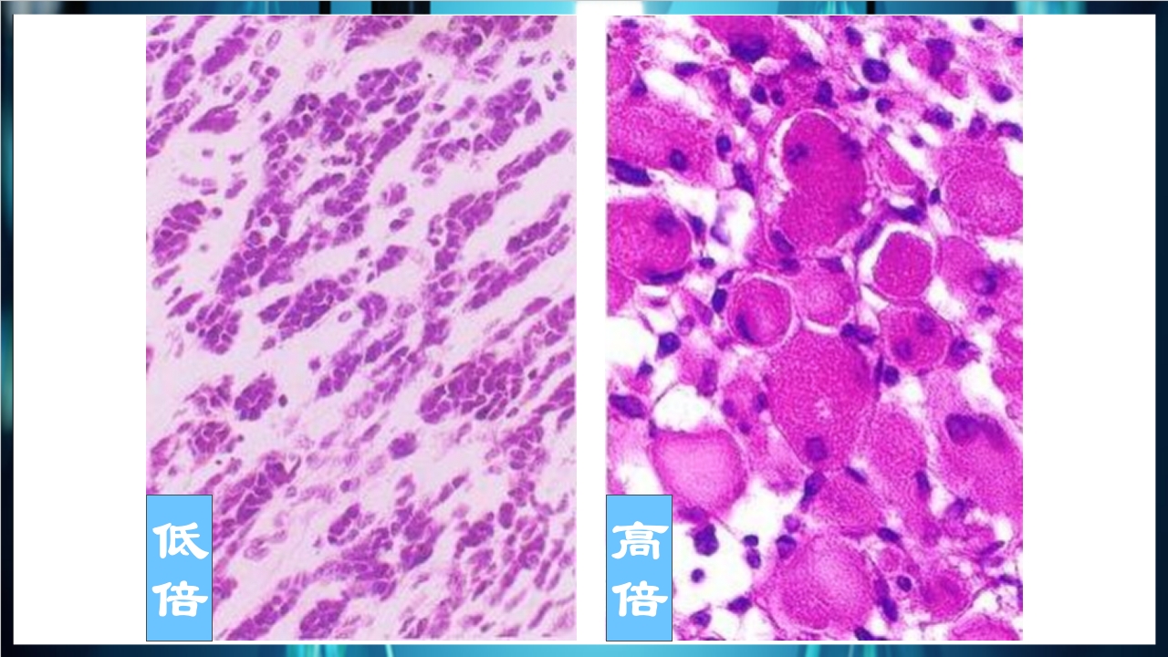 肿瘤病理学简介PPT课件下载43