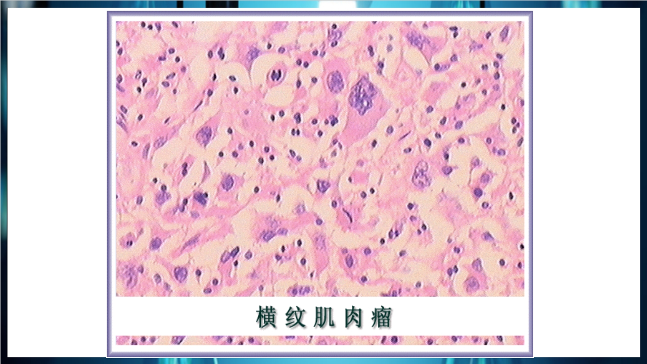 肿瘤病理学简介PPT课件下载44