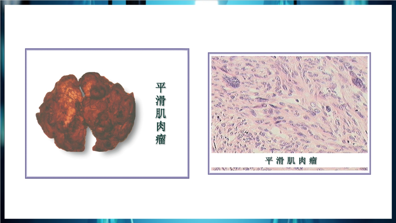 肿瘤病理学简介PPT课件下载45