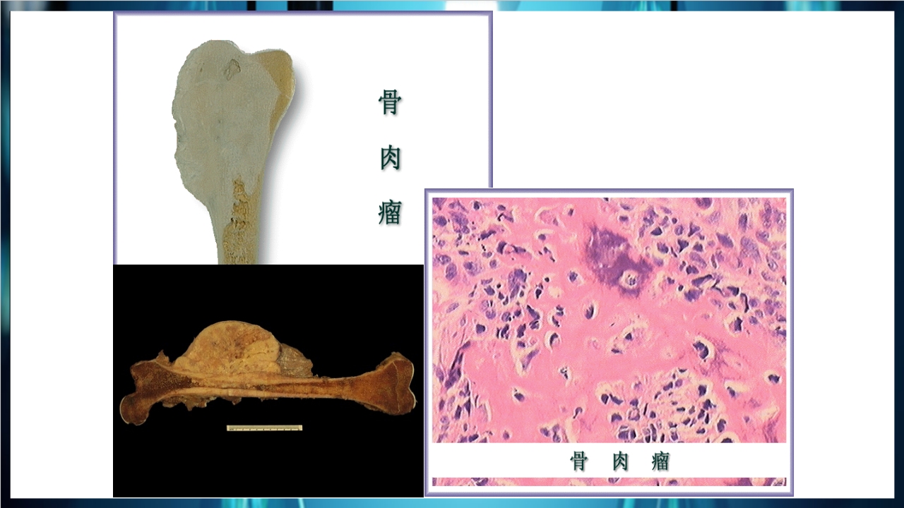 肿瘤病理学简介PPT课件下载47