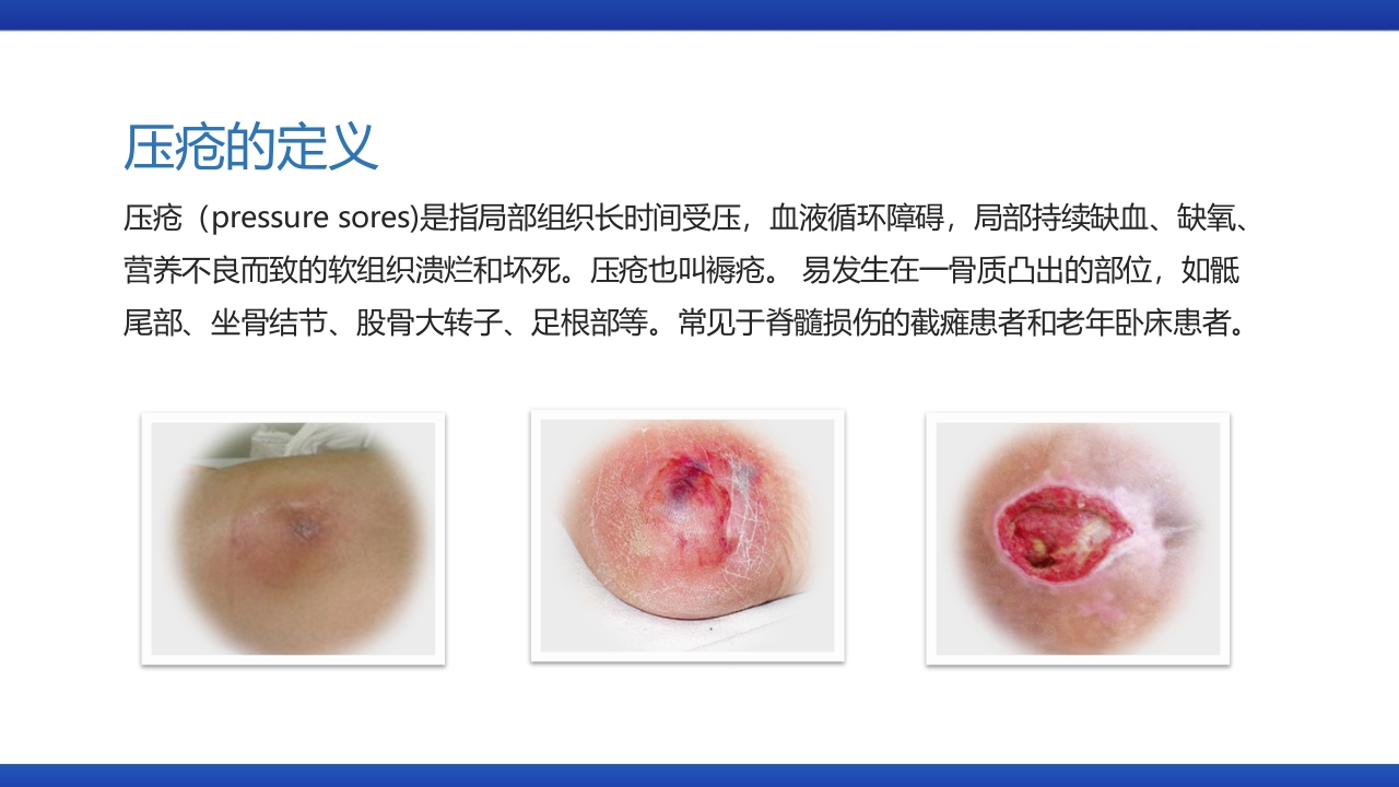 医疗风压疮的预防和护理PPT课件下载4