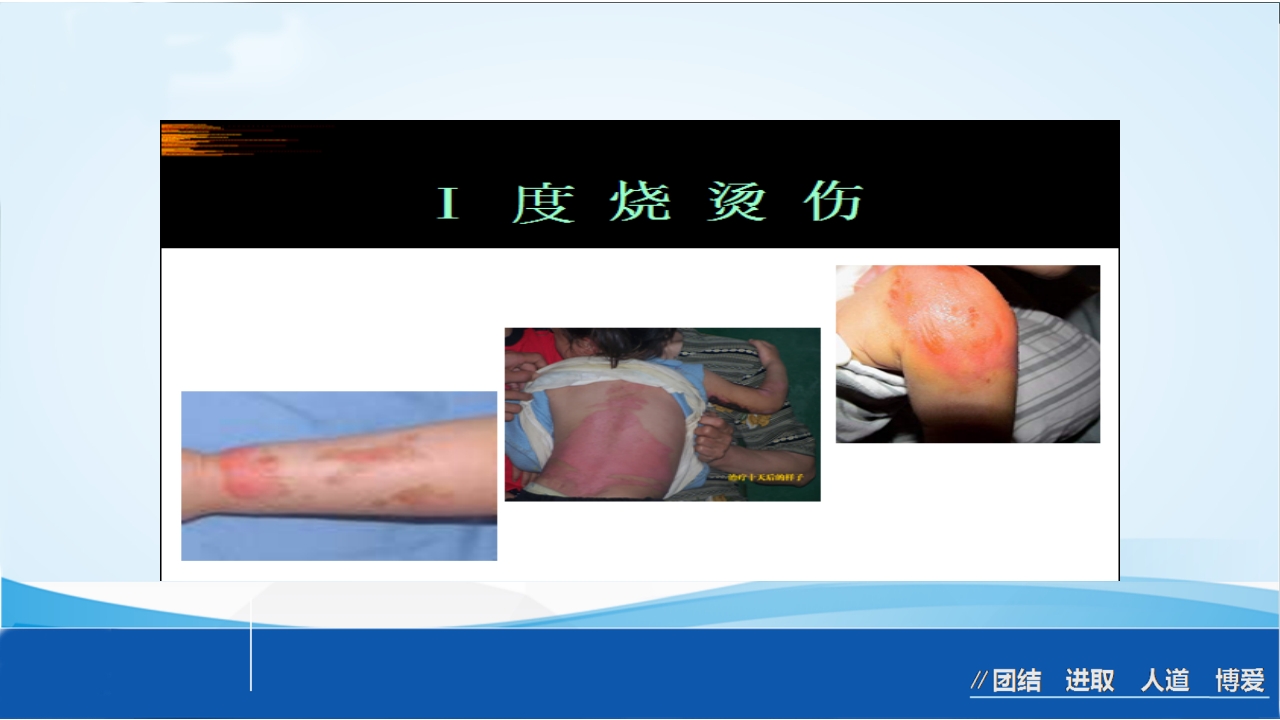烧伤急救处理ppt课件19