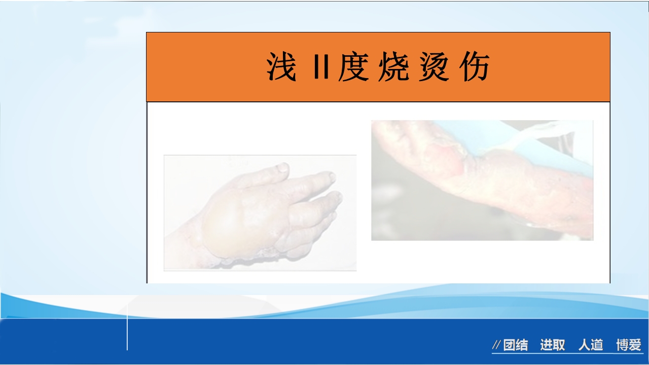 烧伤急救处理ppt课件20