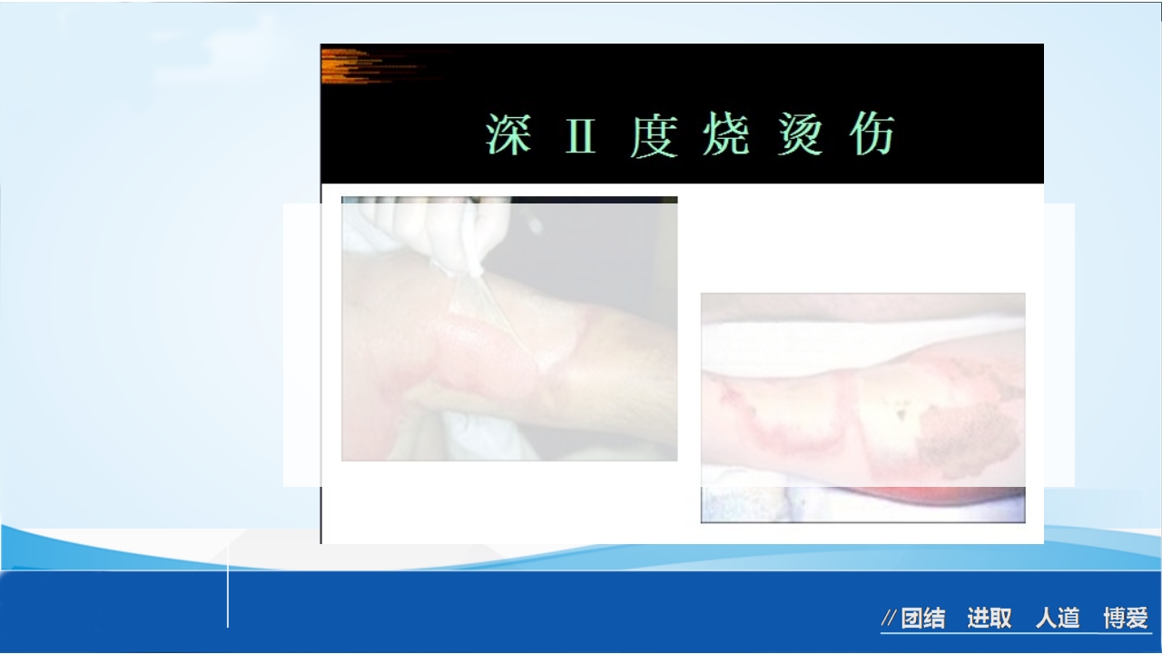 烧伤急救处理ppt课件21