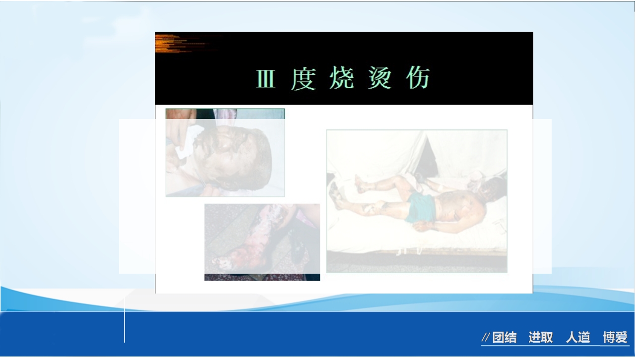 烧伤急救处理ppt课件22