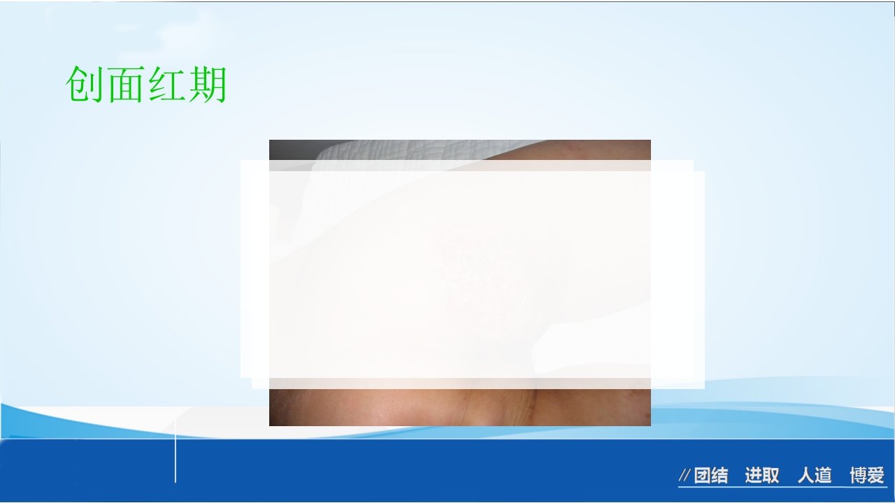 烧伤急救处理ppt课件53