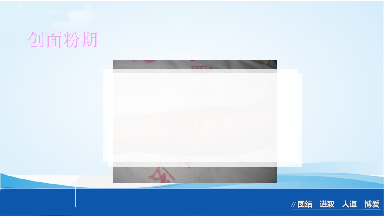 烧伤急救处理ppt课件55