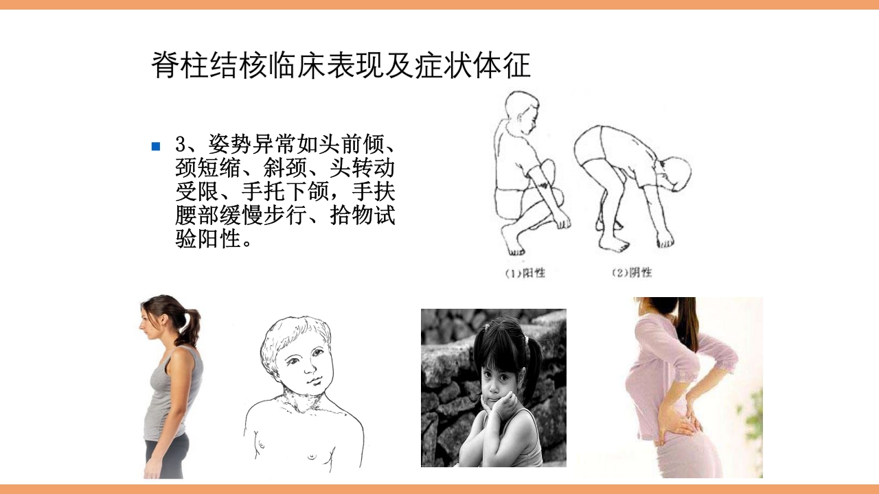 脊柱结核的护理PPT课件下载19