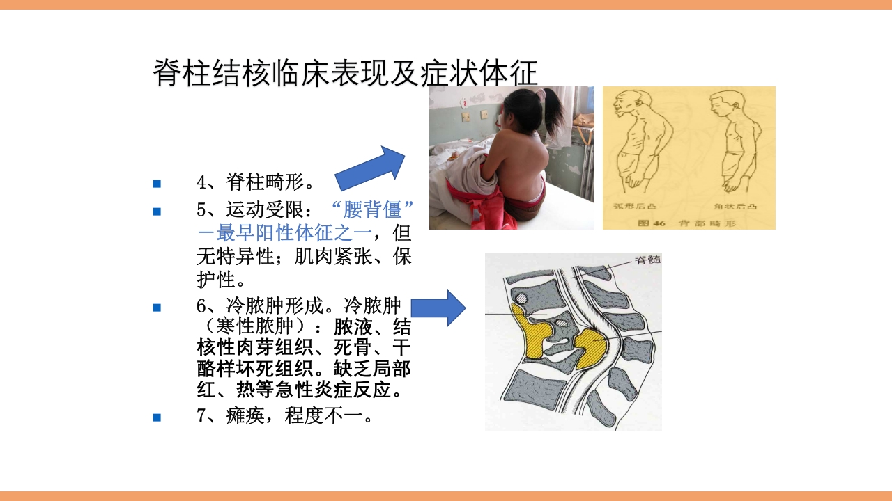 脊柱结核的护理PPT课件下载20