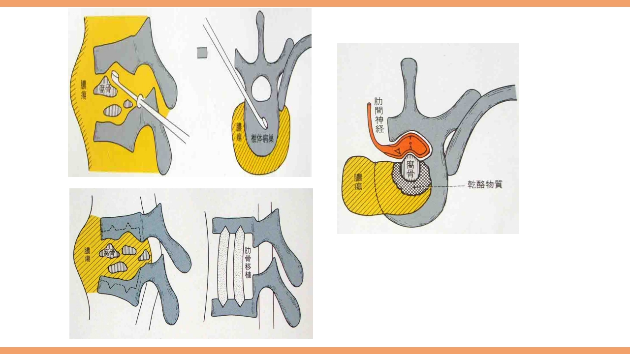 脊柱结核的护理PPT课件下载21