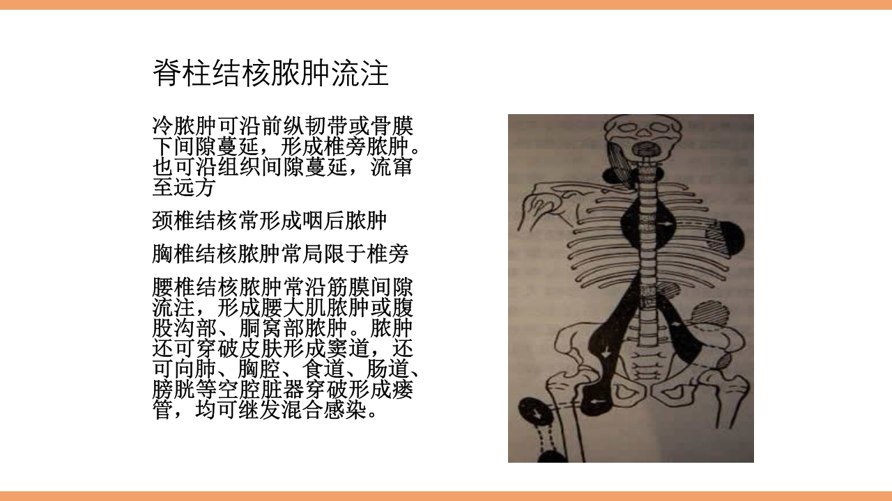 脊柱结核的护理PPT课件下载23