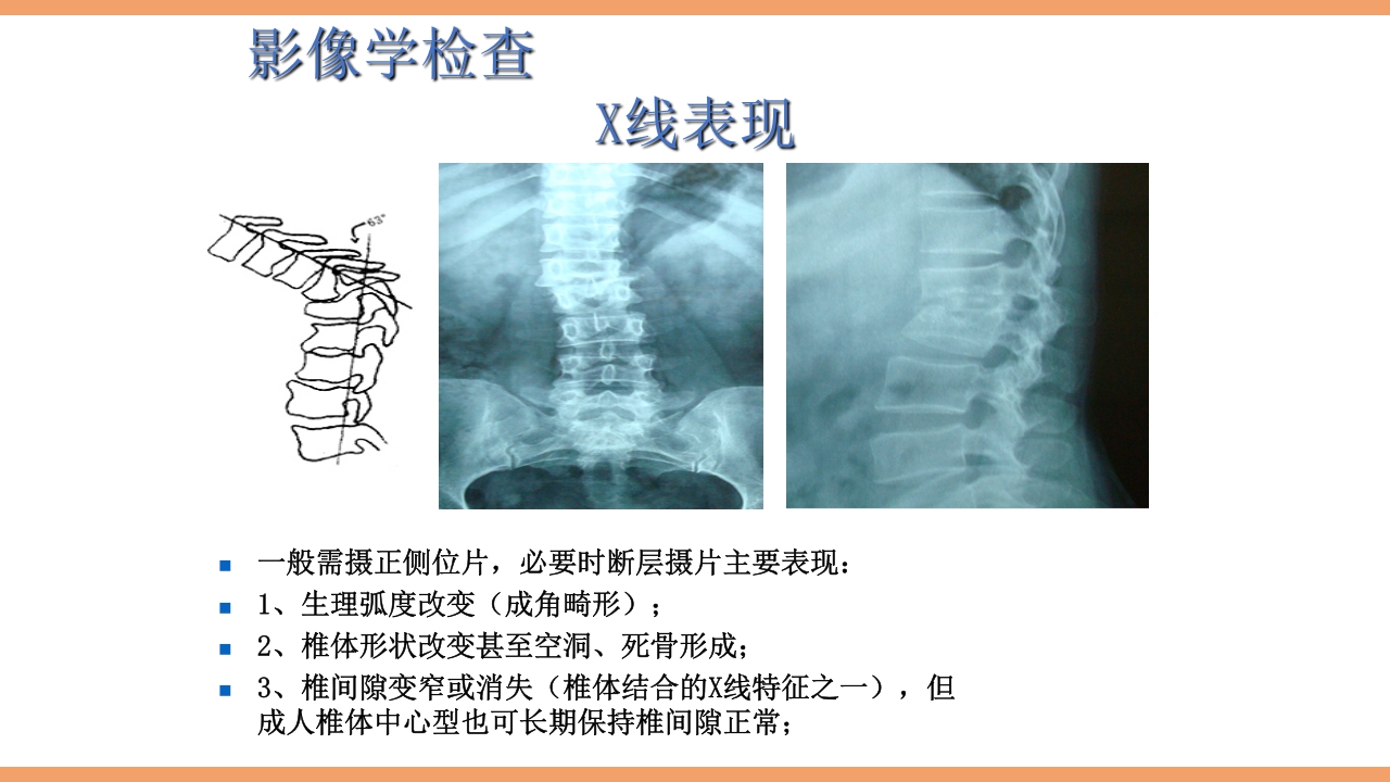 脊柱结核的护理PPT课件下载24