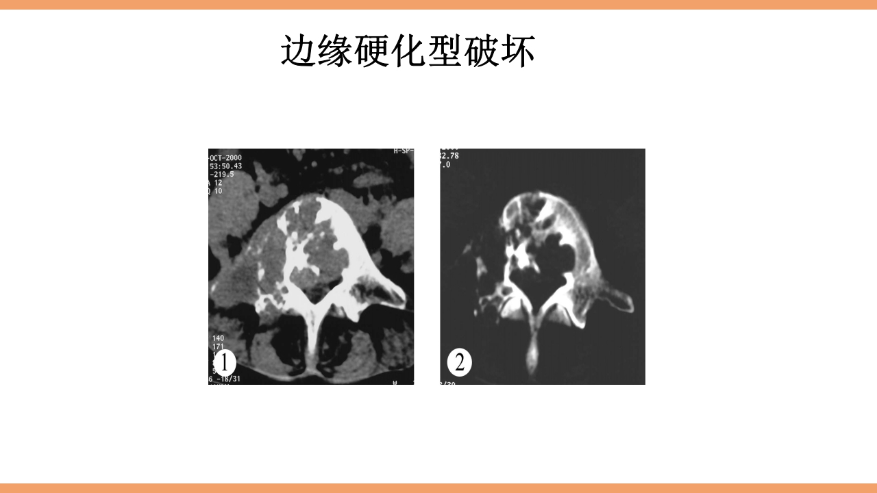脊柱结核的护理PPT课件下载27