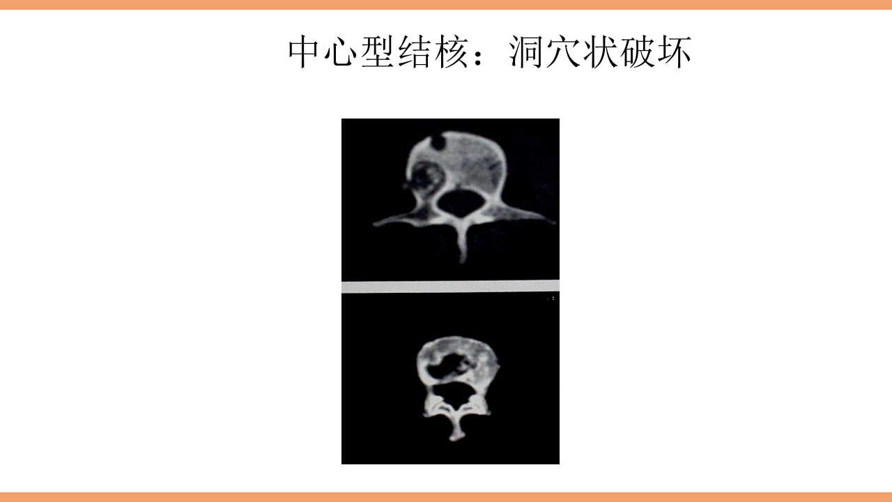 脊柱结核的护理PPT课件下载28