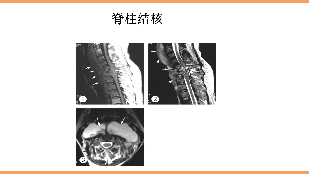 脊柱结核的护理PPT课件下载31