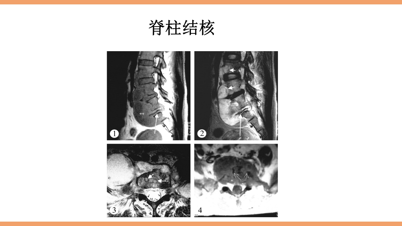 脊柱结核的护理PPT课件下载32