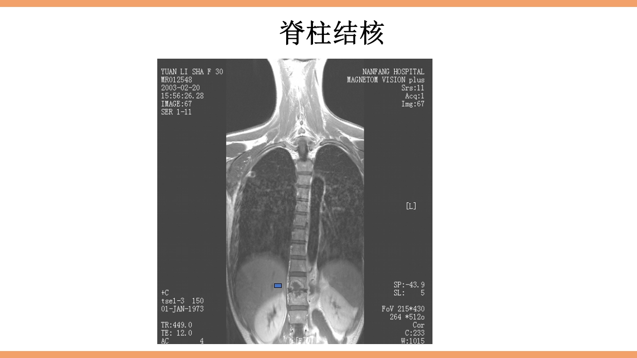 脊柱结核的护理PPT课件下载33