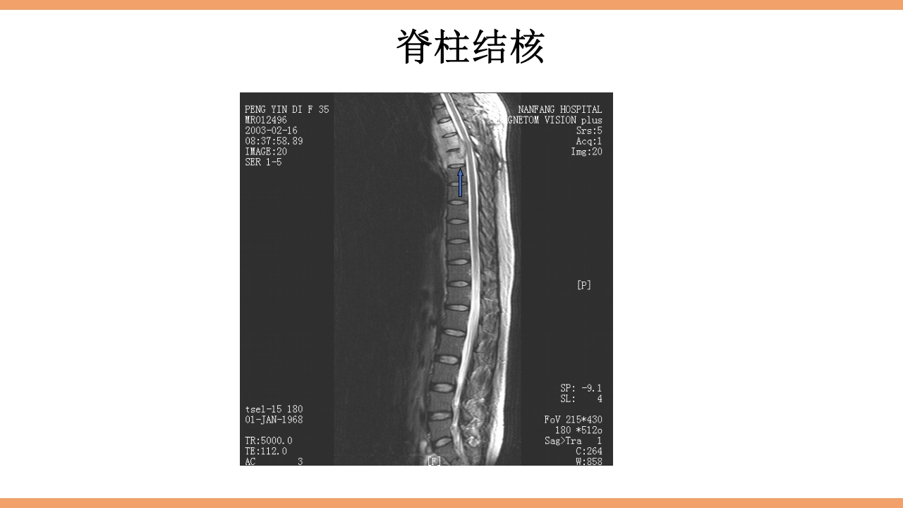 脊柱结核的护理PPT课件下载34