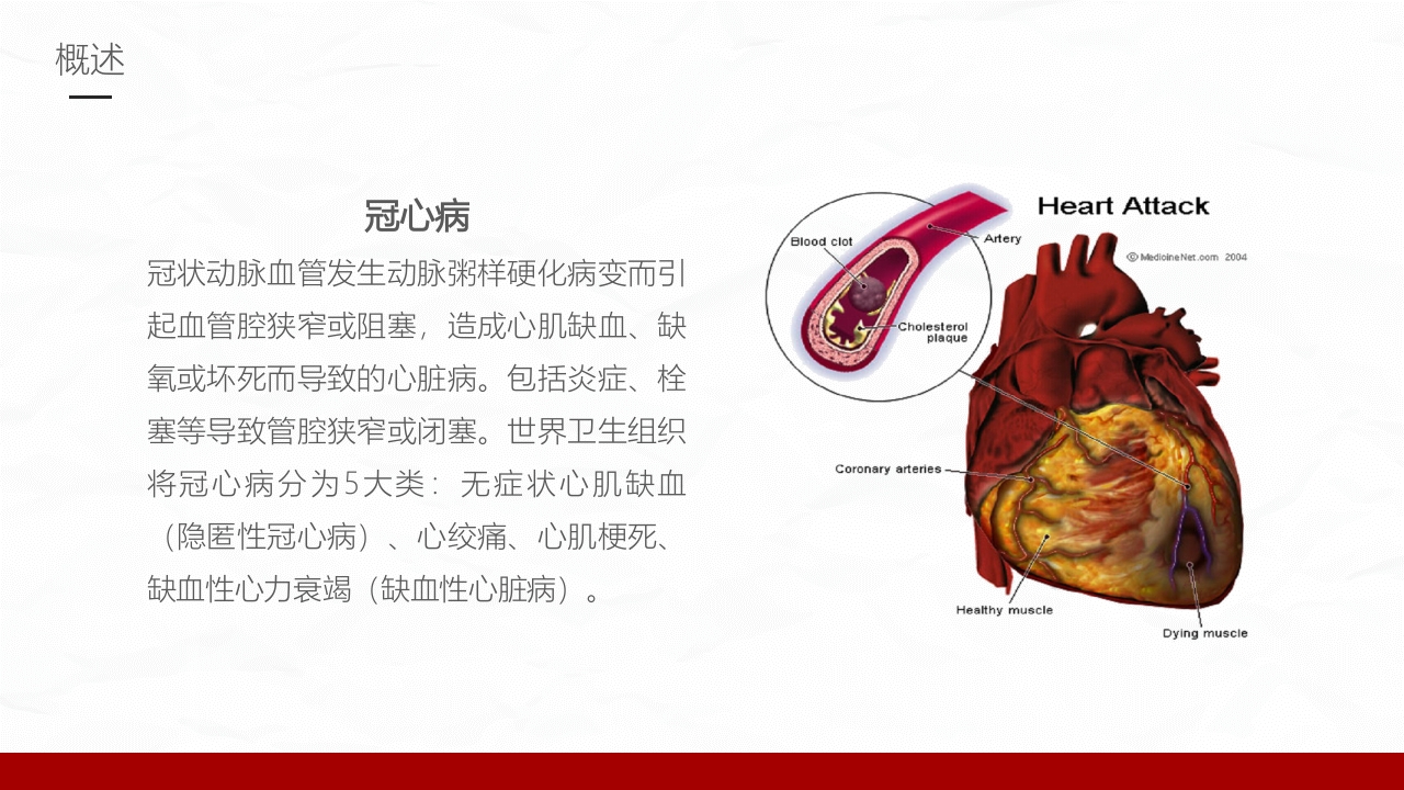 冠心病的护理业务学习课件PPT下载件4