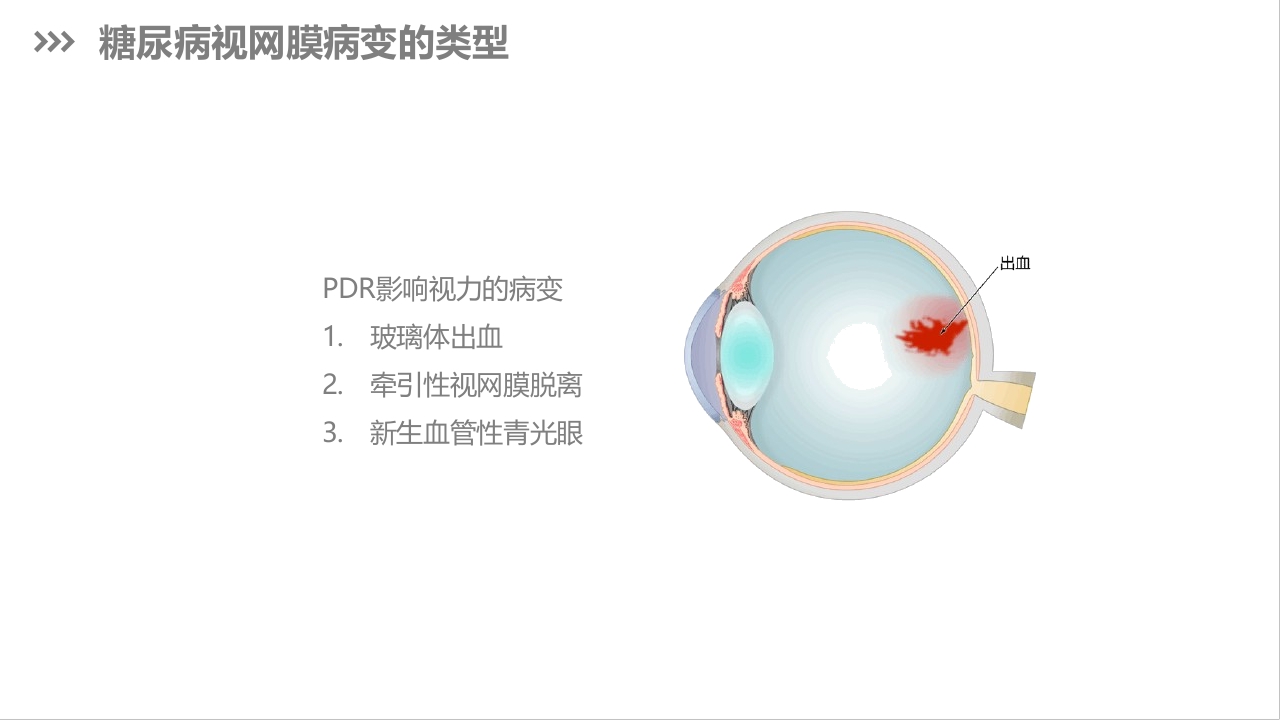糖尿病视网膜病变护理查房PPT课件下载10