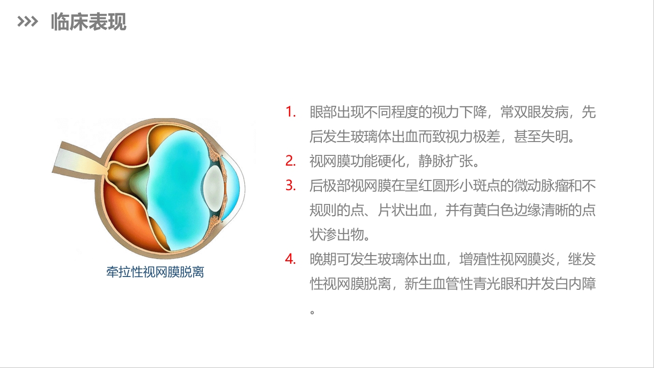 糖尿病视网膜病变护理查房PPT课件下载11