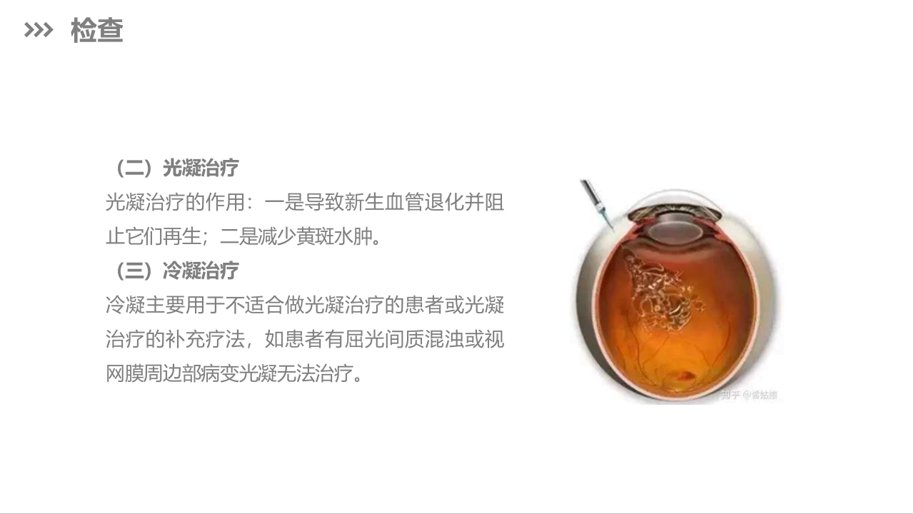 糖尿病视网膜病变护理查房PPT课件下载14
