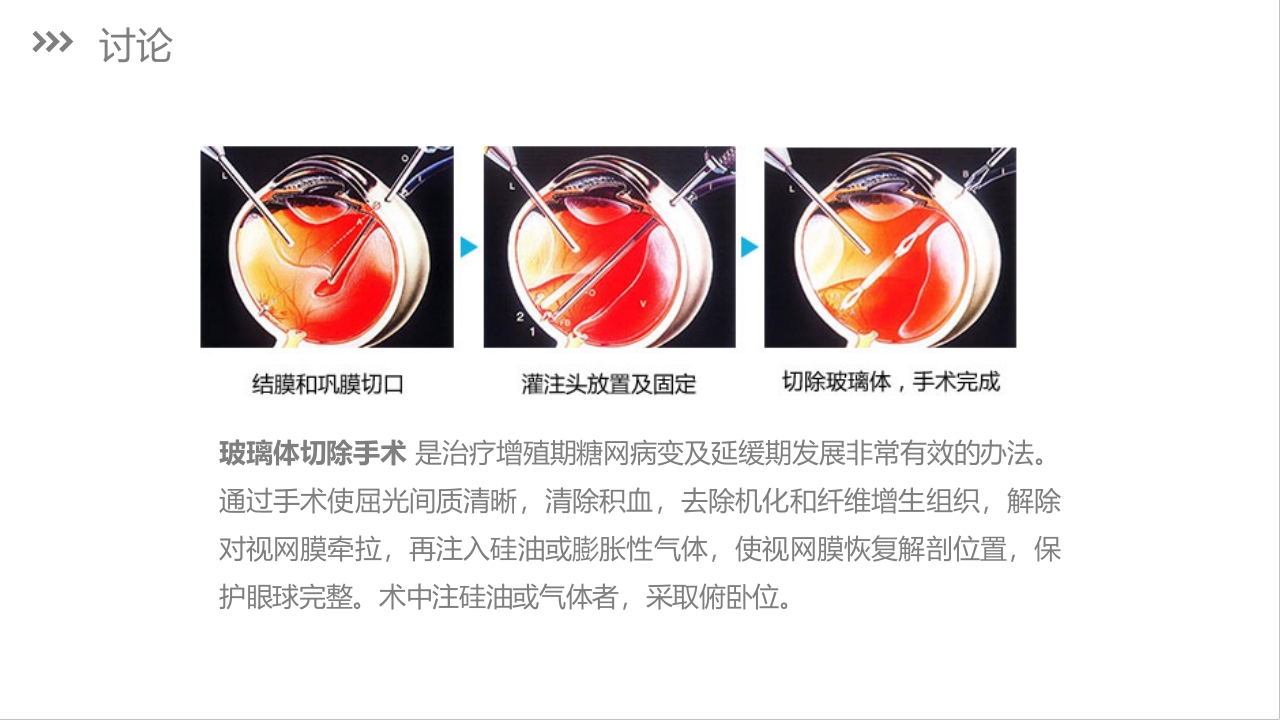 糖尿病视网膜病变护理查房PPT课件下载35