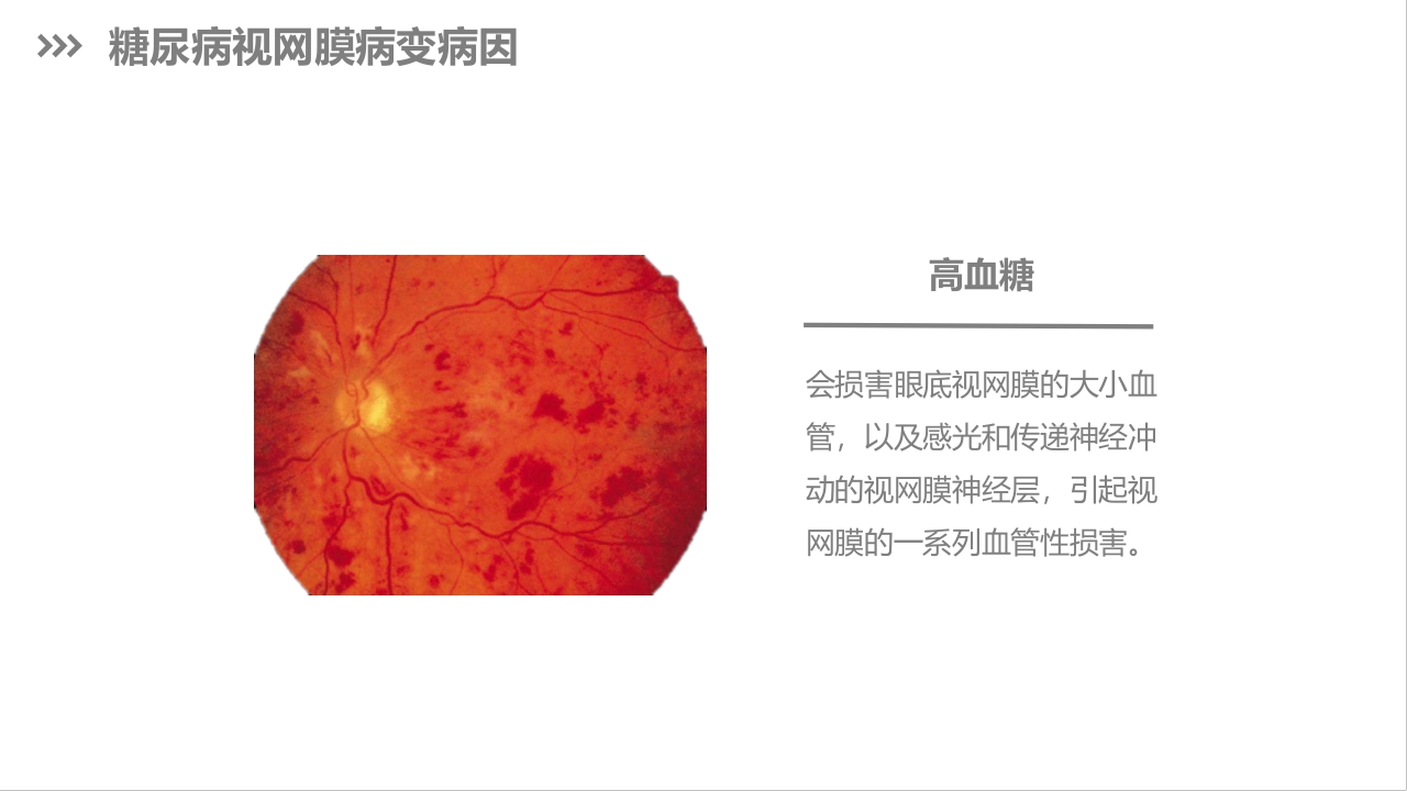 糖尿病视网膜病变护理查房PPT课件下载5