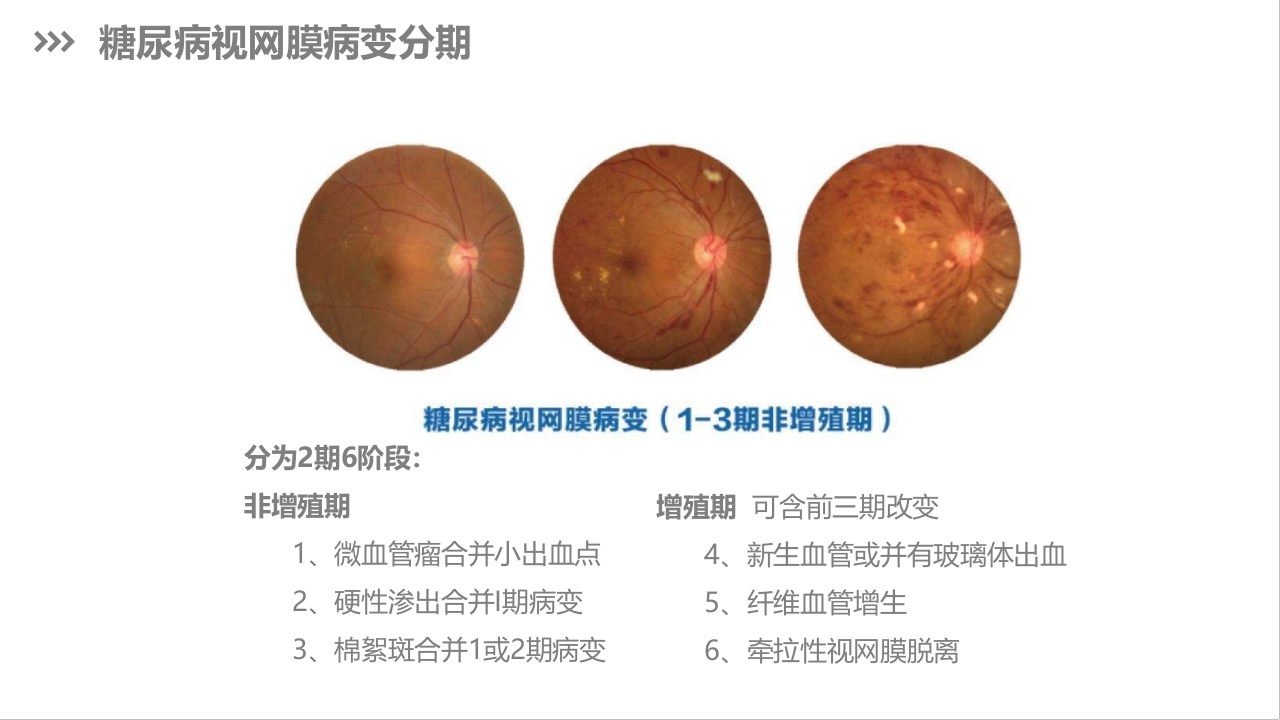 糖尿病视网膜病变护理查房PPT课件下载6