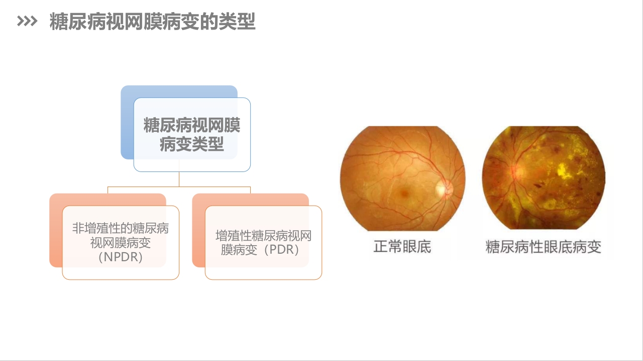 糖尿病视网膜病变护理查房PPT课件下载7