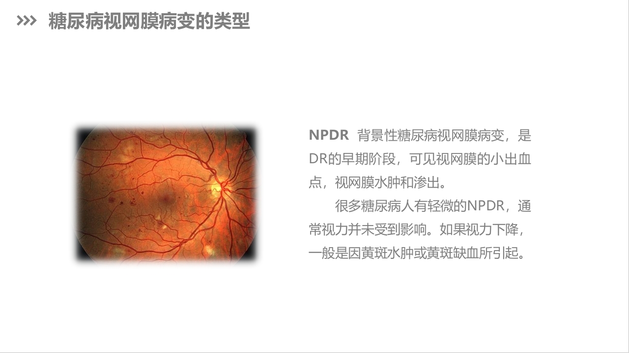 糖尿病视网膜病变护理查房PPT课件下载8