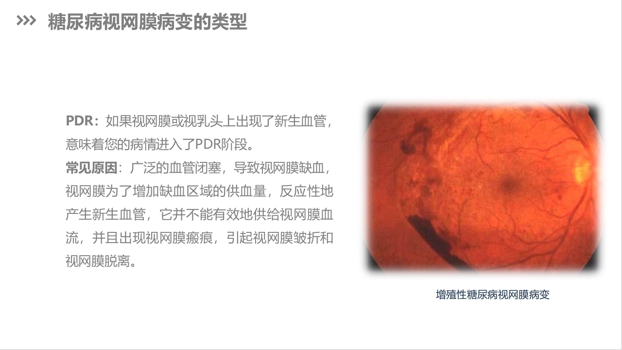 糖尿病视网膜病变护理查房PPT课件下载9