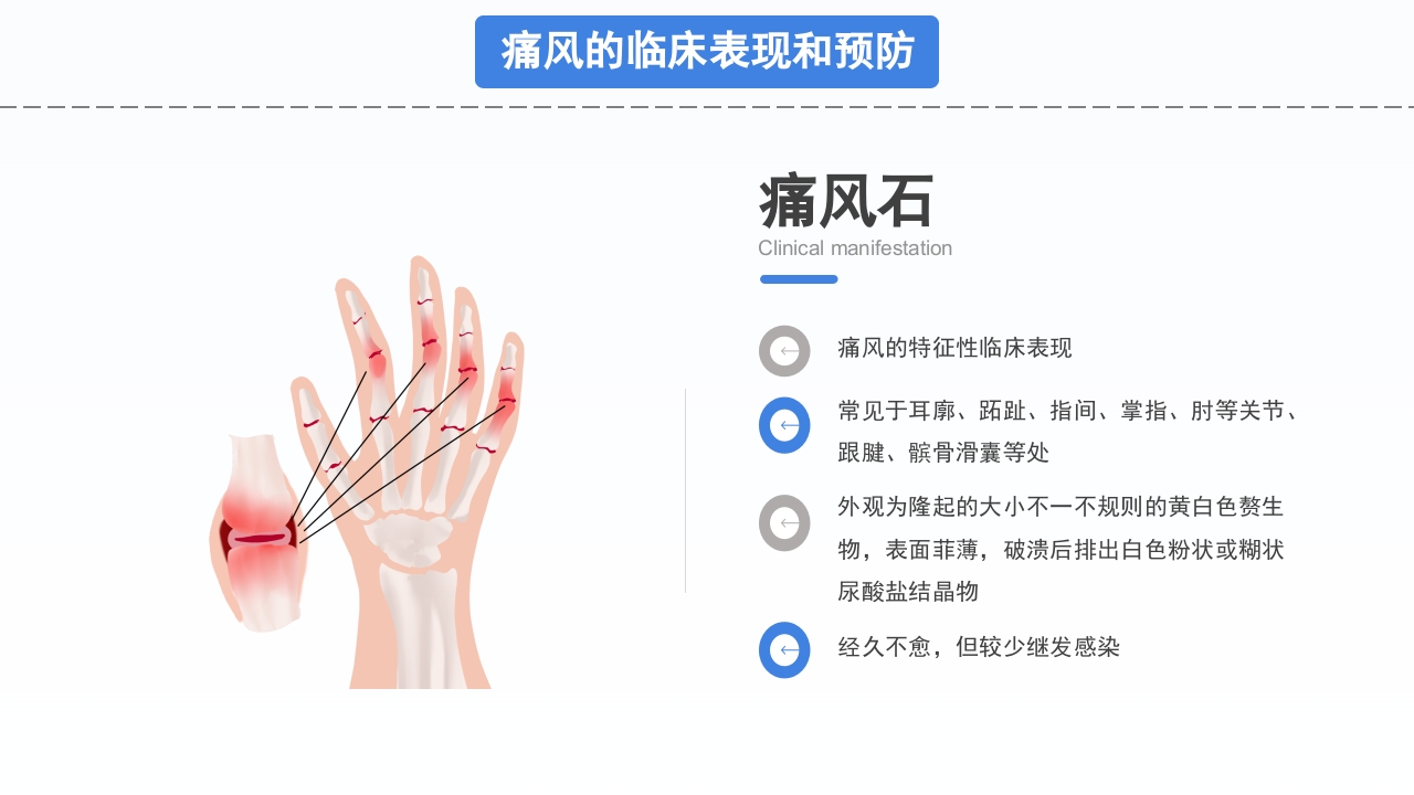 风湿性痛风知识宣讲PPT课件下载12