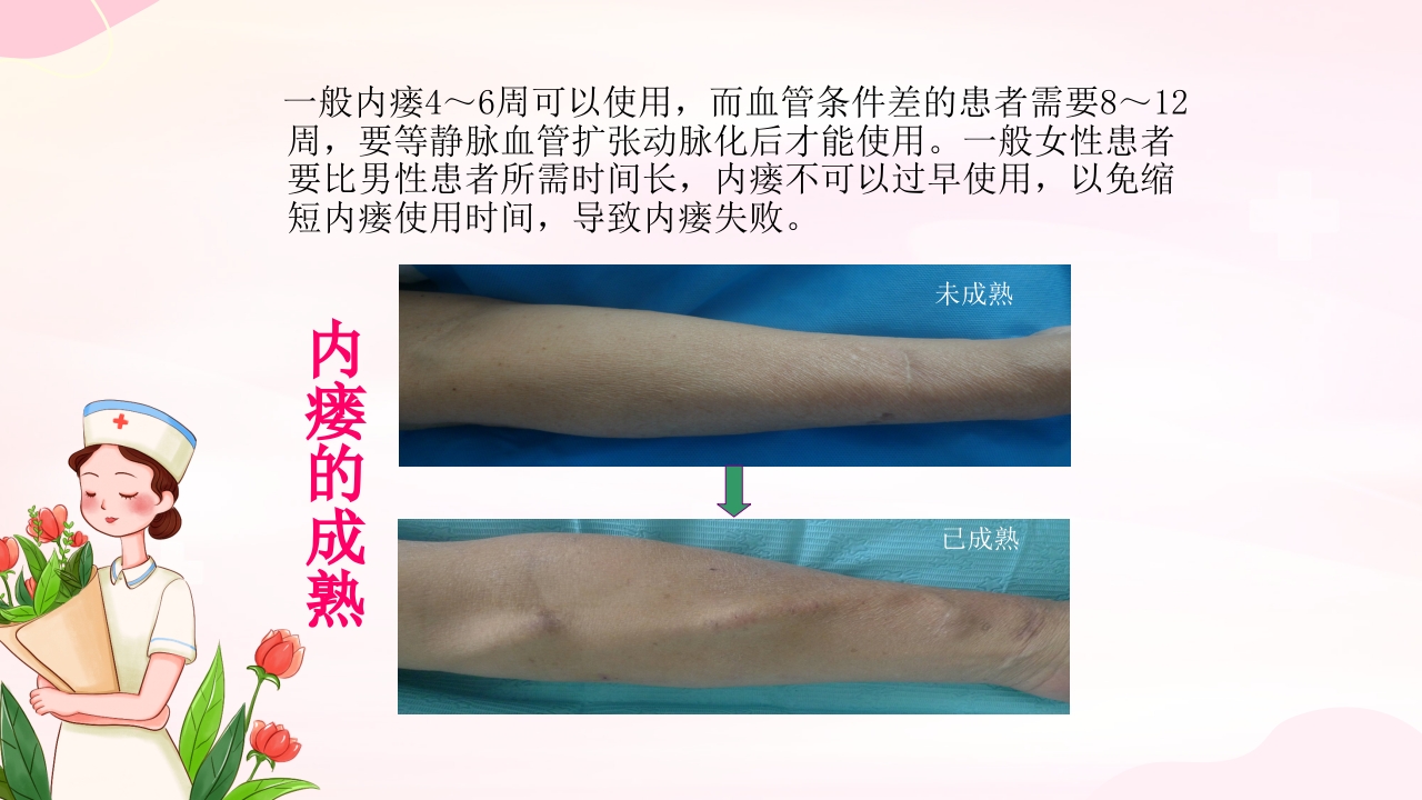 动静脉内瘘的手术配合护理PPT课件23