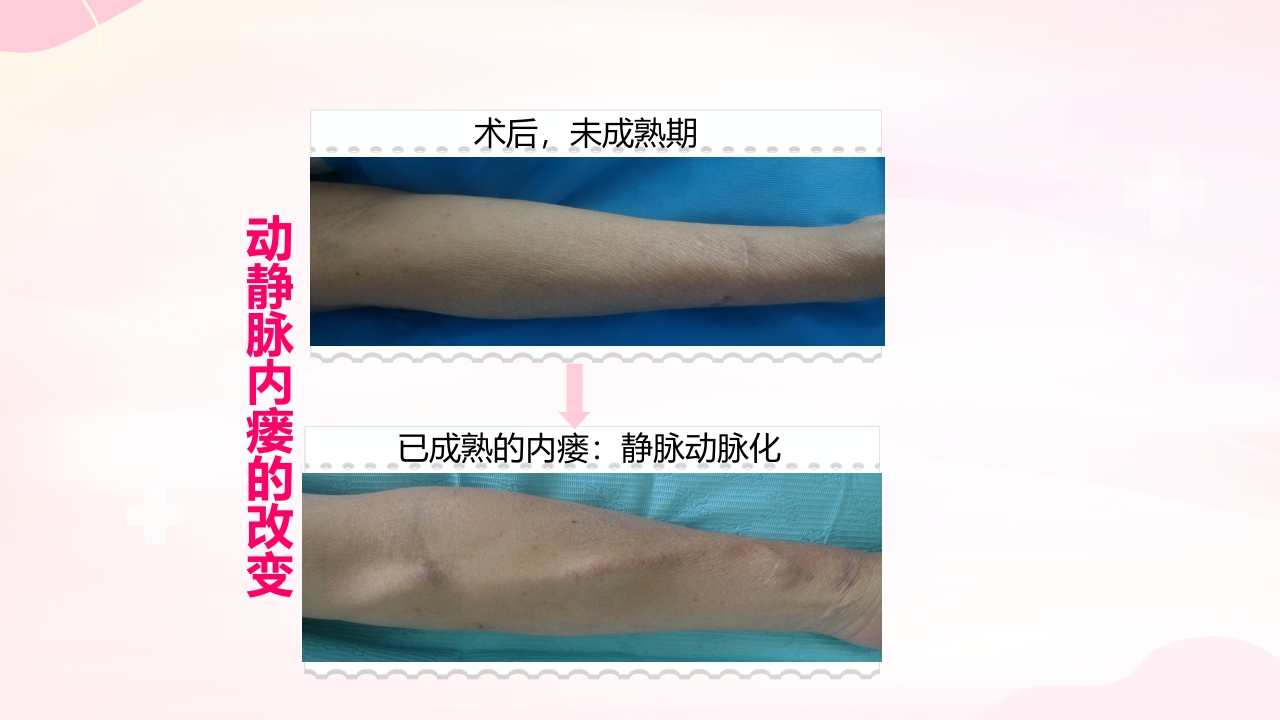 动静脉内瘘的手术配合护理PPT课件5
