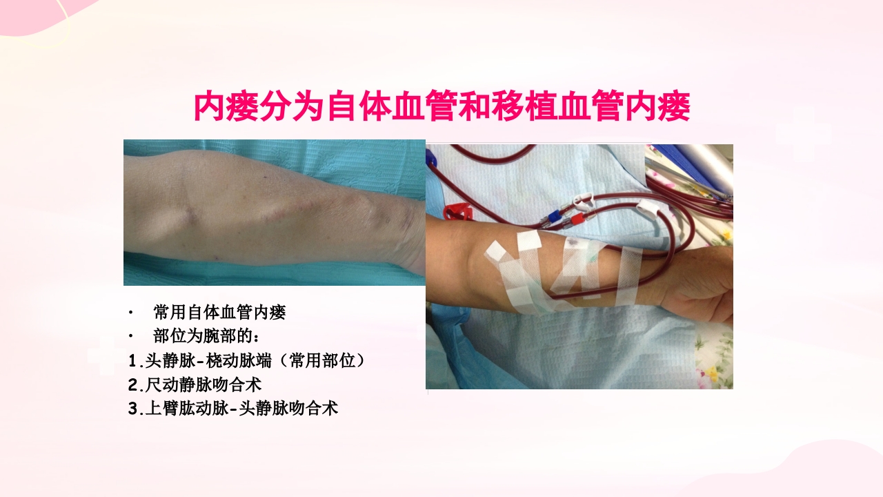 动静脉内瘘的手术配合护理PPT课件6