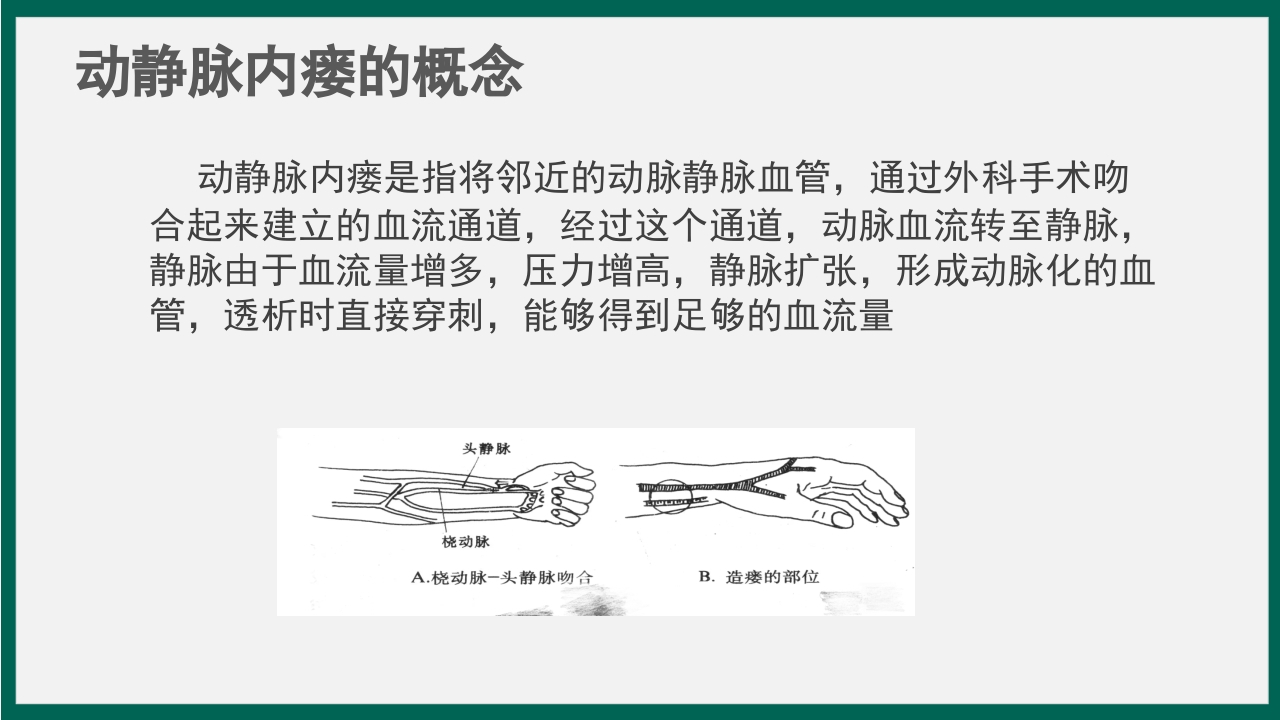 血透患者动静脉内瘘的护理PPT课件2