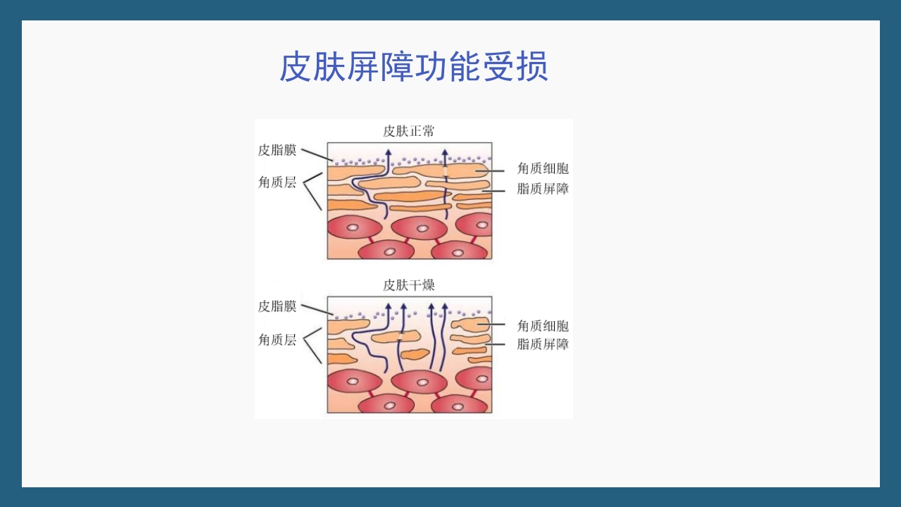 敏感性皮肤及修复策略PPT课件22