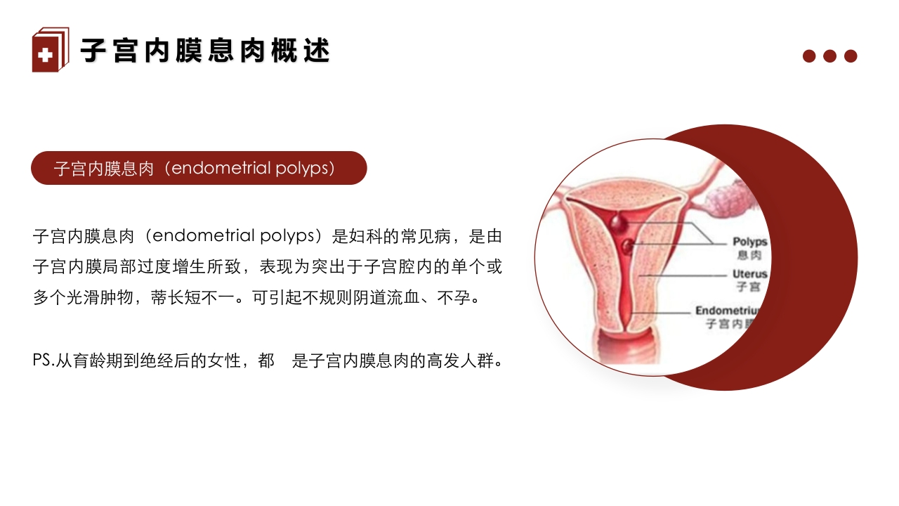 妇科疾病·子宫内膜息肉的护理PPT课件4