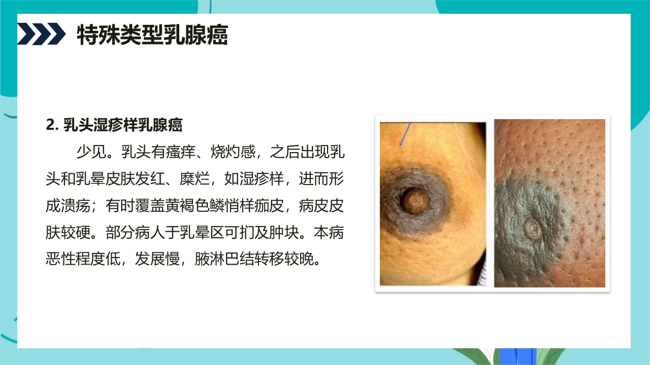 乳腺癌患者术后护理查房PPT课件9