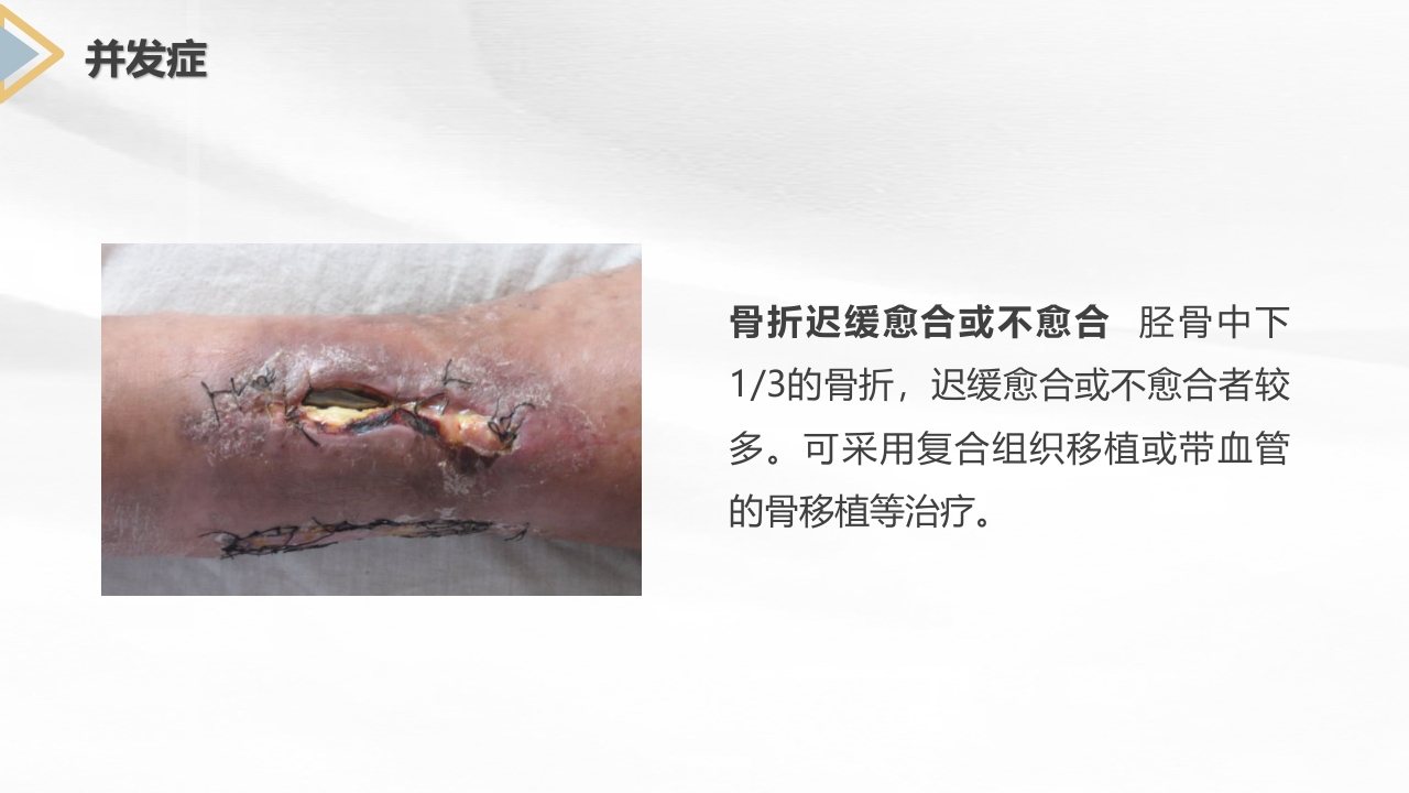 胫腓骨骨折护理查房PPT课件10