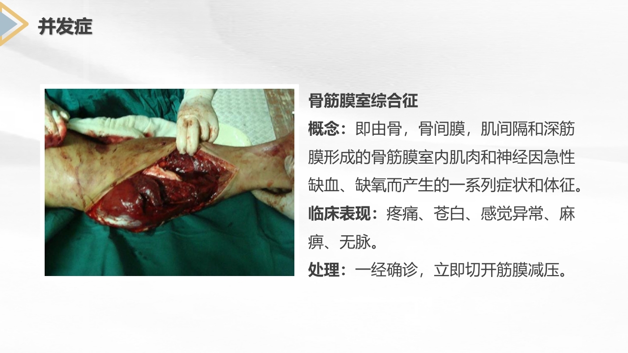 胫腓骨骨折护理查房PPT课件11