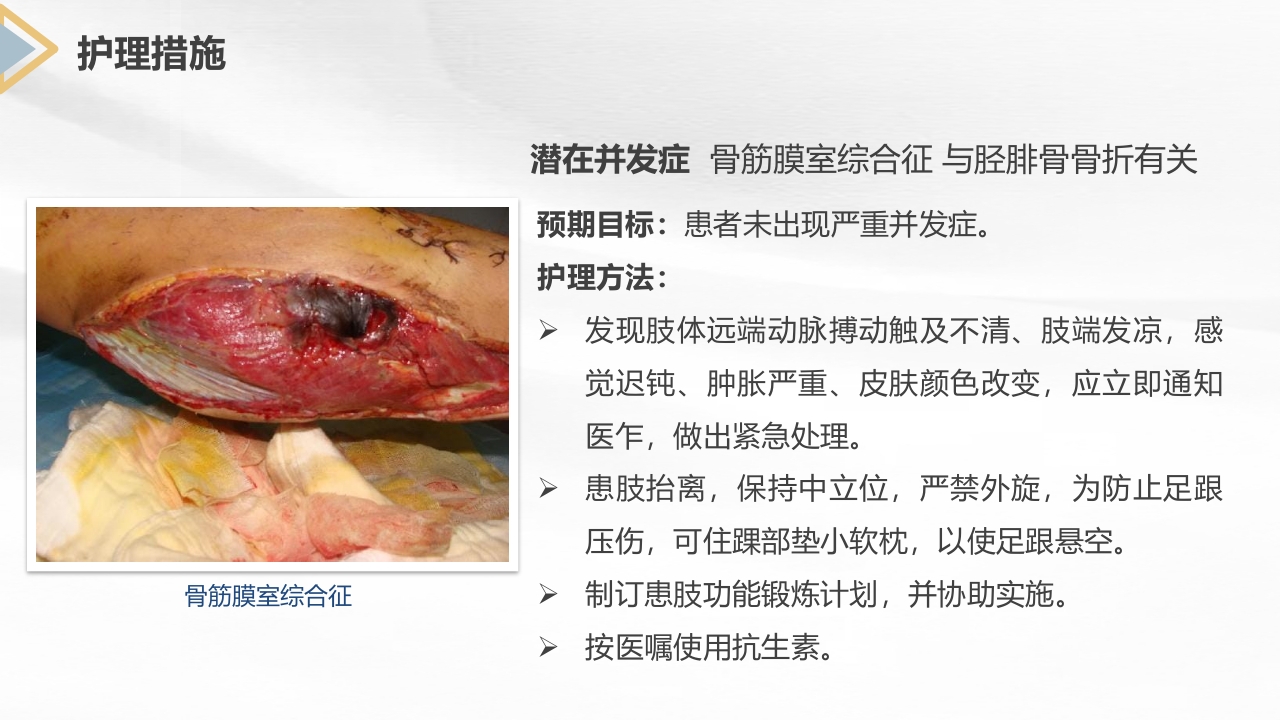 胫腓骨骨折护理查房PPT课件30