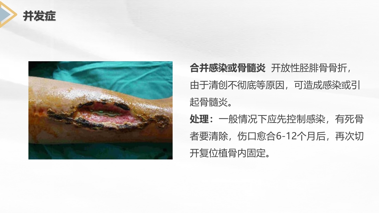 胫腓骨骨折护理查房PPT课件9
