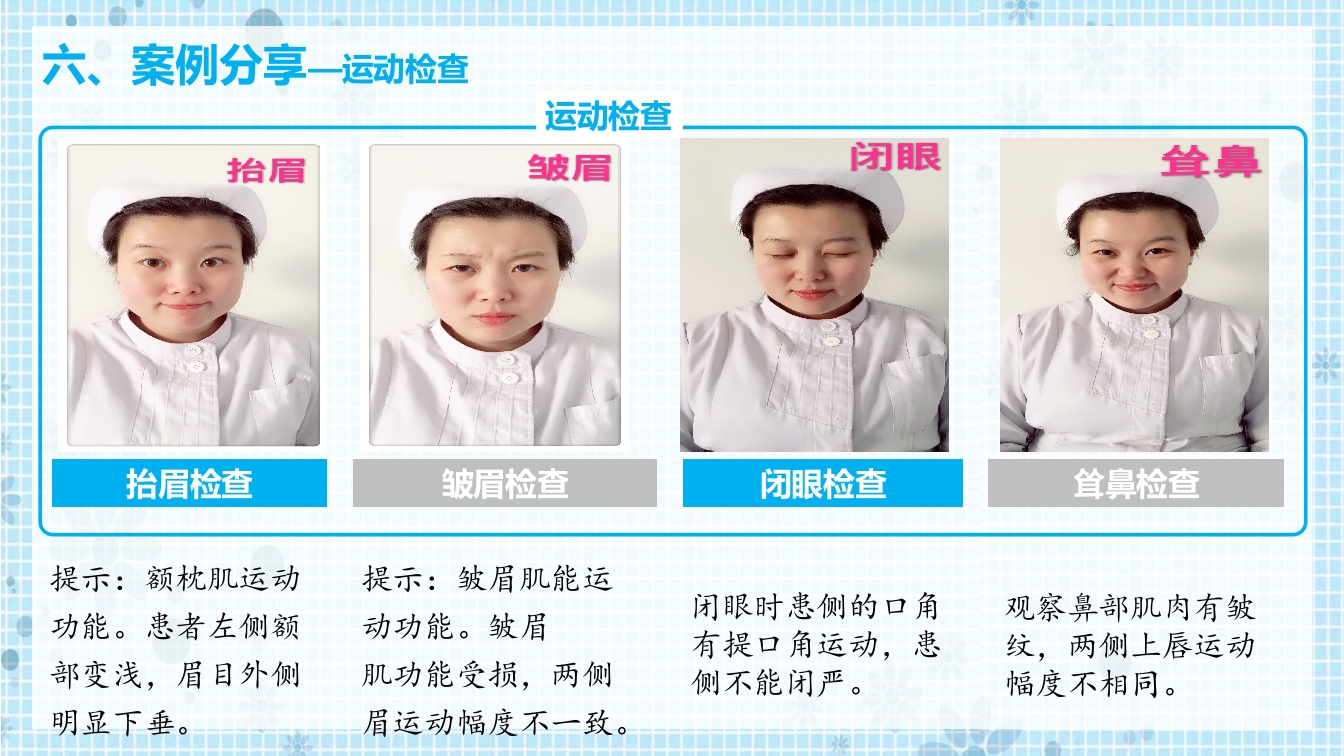 面瘫病人的护理PPT课件13